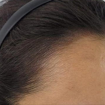 Before and after comparison of hairline treatment on a person's forehead.